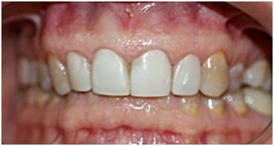 Глубокий прикус – полное перекрытие нижнего зубного ряда верхним.