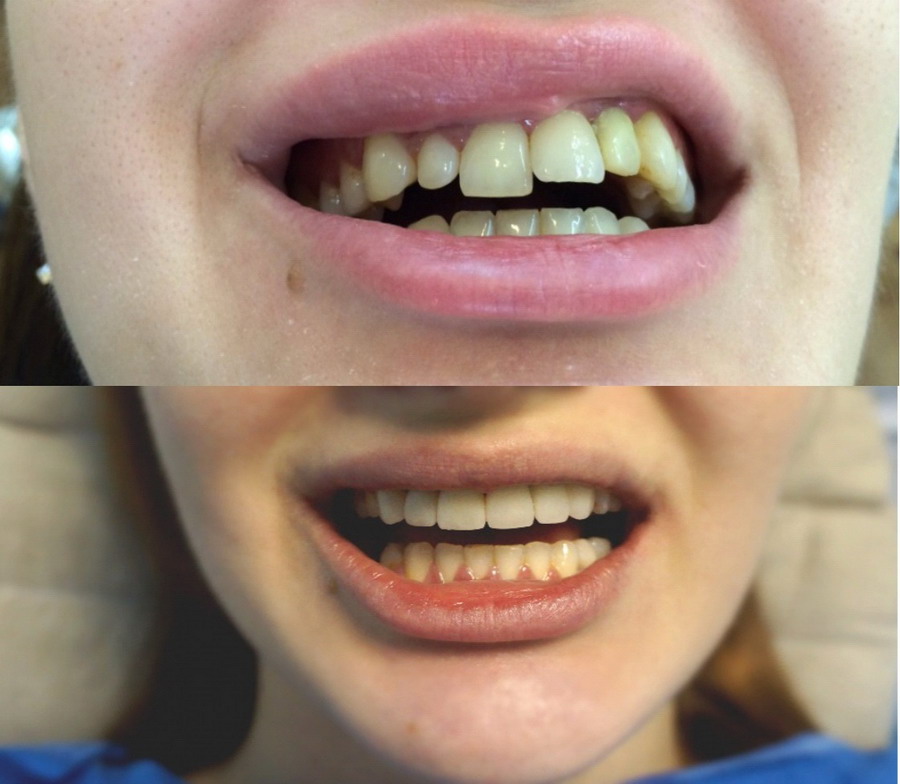 Коррекция улыбки с помощью эстетической стоматологии - Фото "До и после"