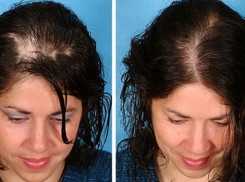 Процедура «Мезотерапия для волос» "До и после" - фото №1