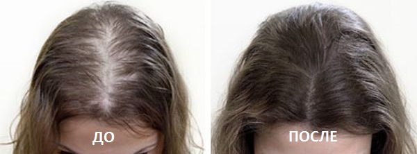 Процедура «Мезотерапия для волос» "До и после" - фото №2