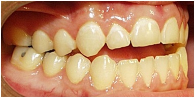 Открытый прикус – отсутствие контакта зубов между рядами.
