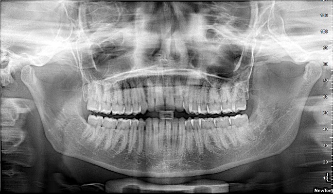 Ортопантомограмма (ОПТГ) - полученный снимок